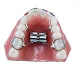 palatal expander